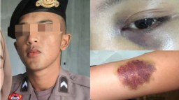 VIRAL! Oknum Polisi Biddokkes Polda Jabar Aniaya Pacarnya Hingga Lebam dan Memar